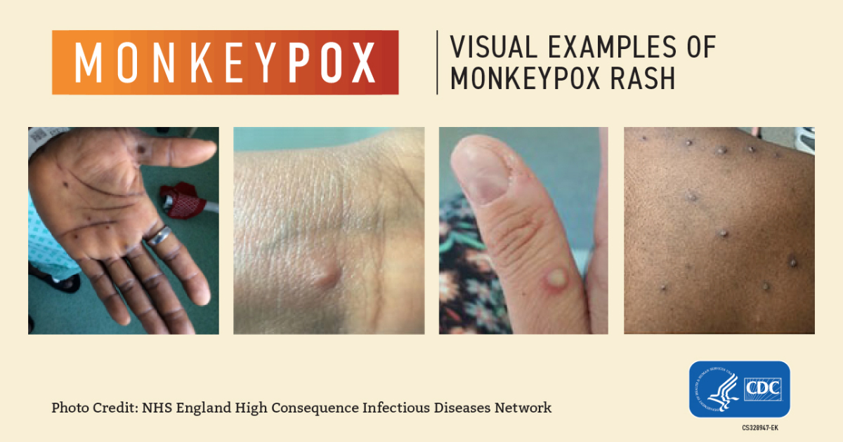 Is Monkeypox the new Covid?